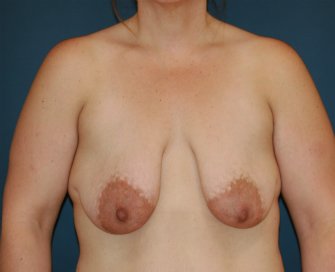 Breasts Uplifted San Diego - before - front
