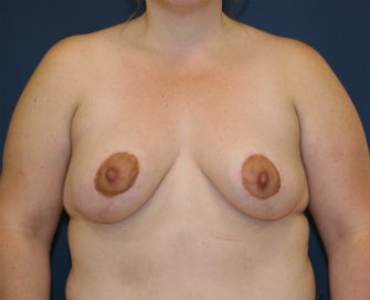 Breasts Uplifted San Diego - after - front