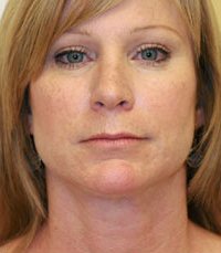 Necklift Case 2 - after - side