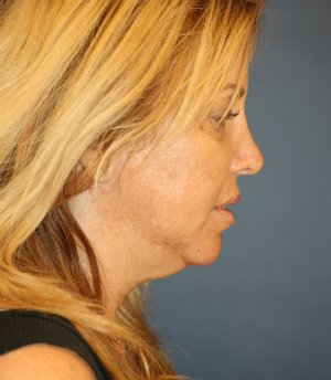 Neck Lift - before - front