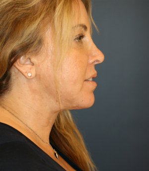 Neck Lift - after - front