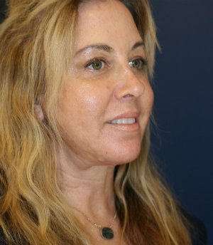 Neck Lift - after - oblique