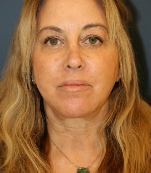 Neck Lift - after - side