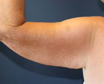 Left Arm Lift San Diego after weight loss - before - front