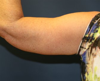 Left Arm Lift San Diego after weight loss - after - front