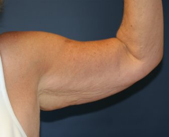 Left Arm Lift San Diego after weight loss - before - back