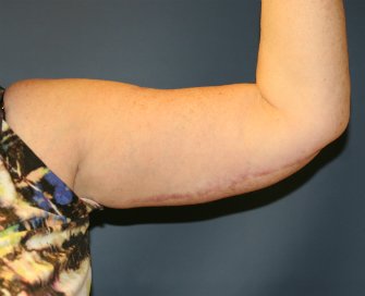 Left Arm Lift San Diego after weight loss - after - back