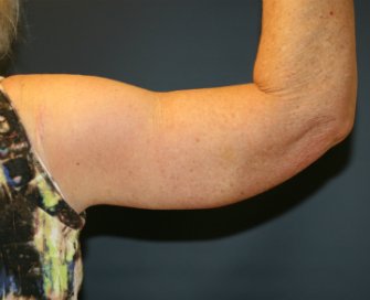 Right Arm Lift After Weight Loss San Diego - after - back