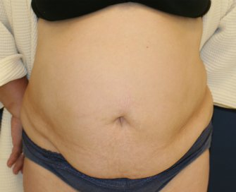 Tummy-Tuck-for-hanging-skin - before - front