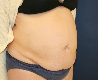 Tummy-Tuck-for-hanging-skin - before - oblique