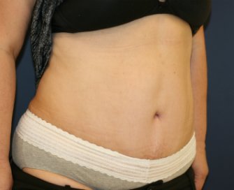 Tummy-Tuck-for-hanging-skin - after - oblique