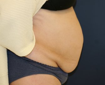 Tummy-Tuck-for-hanging-skin - before - side