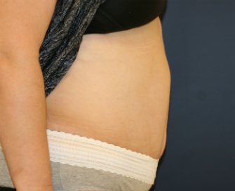 Tummy-Tuck-for-hanging-skin - after - side