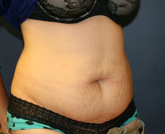 Tummy-Tuck-Vietnam-San-Diego - before - oblique