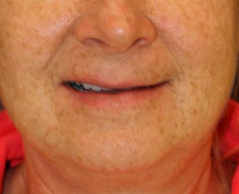 Lip Lift (naturally asymmetric) - before - front