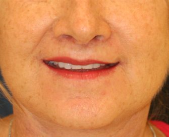 Lip Lift (naturally asymmetric) - after - front