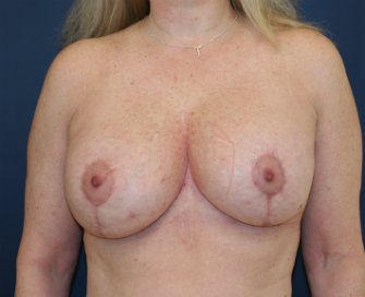 Breast Lift San Diego (implants not changed) - after - front