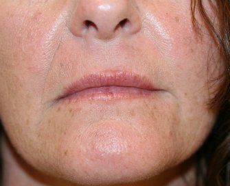 Upper Lip and Corner of Lip Lift - before - front