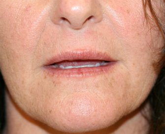 Upper Lip and Corner of Lip Lift - before - lips parted