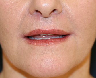 Upper Lip and Corner of Lip Lift - after - lips parted