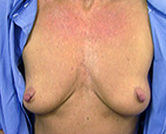 Breast Augmentation Case 14 - before - front