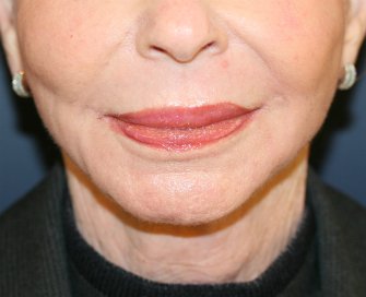 Jowl Removal (non-surgical facelift) - after - front