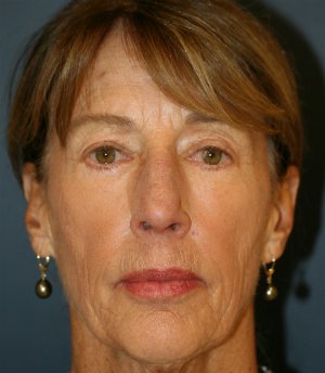 Laser-Wrinkle-Treatment - before - front