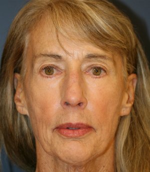 Laser-Wrinkle-Treatment - after - front