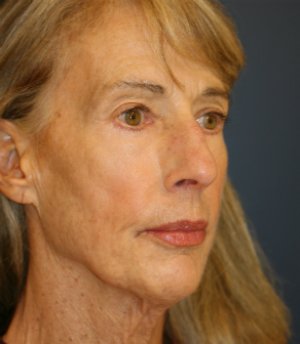 Laser-Wrinkle-Treatment - after - oblique