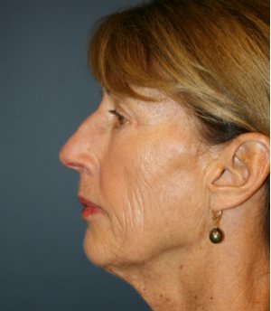 Laser-Wrinkle-Treatment - before - side