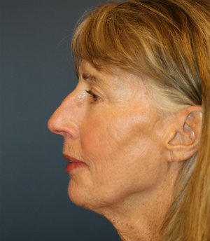 Laser-Wrinkle-Treatment - after - side