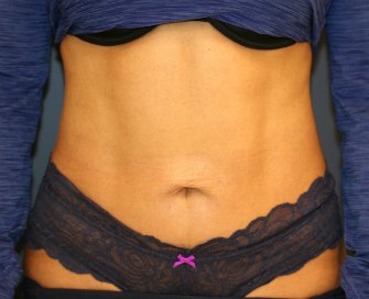 Tummy Tuck Loose Skin Only - after - front