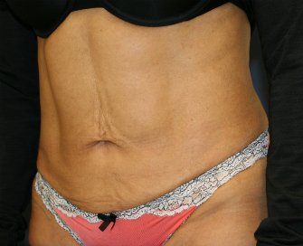 Tummy Tuck Loose Skin Only - before - oblique