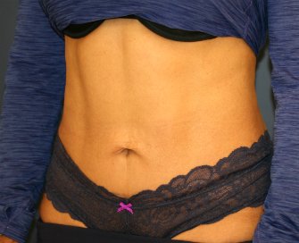Tummy Tuck Loose Skin Only - after - oblique