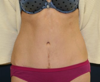 Tummy Tuck after three boys - after - side