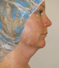 Necklift Case 2 - before - front