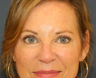 Upper Eyelids Removal Sagging Skin - after - front