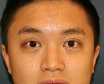 Double Eyelid (Asian) - after - front