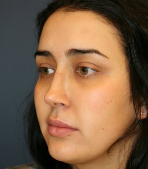 Revision Rhinoplasty - before - oblique