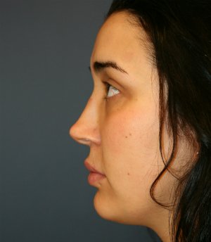 Revision Rhinoplasty - before - side