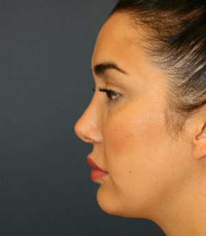 Revision Rhinoplasty - after - side