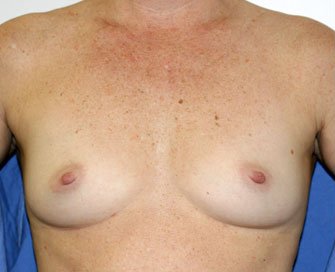 Breast Augmentation Case 15 - before - front