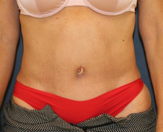 Tummy-Tuck-and-Liposuction-Waist - after - front
