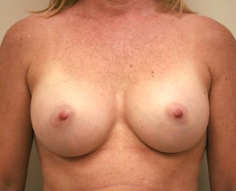 Breast Augmentation Case 15 - after - front