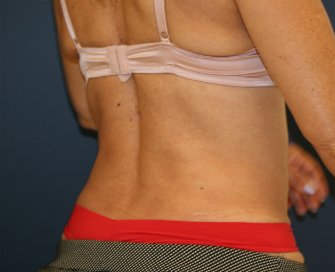 Liposuction Waist - after - oblique