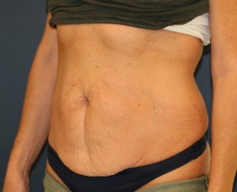 Tummy-Tuck-for-loose-skin - before - front