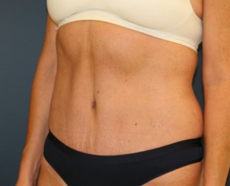 Tummy-Tuck-for-loose-skin - after - front