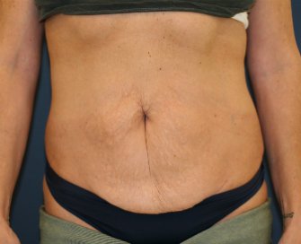 Tummy-Tuck-for-loose-skin - before - oblique