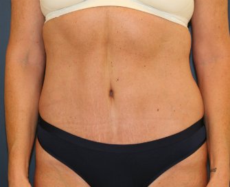 Tummy-Tuck-for-loose-skin - after - oblique