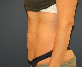 Tummy-Tuck-for-loose-skin - before - side